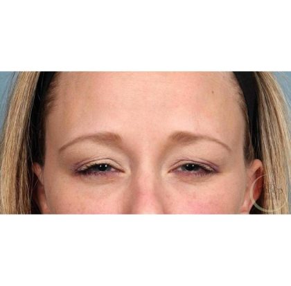 Botox Before & After Patient #9087