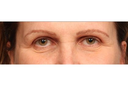 Brow Lift Before & After Patient #8868