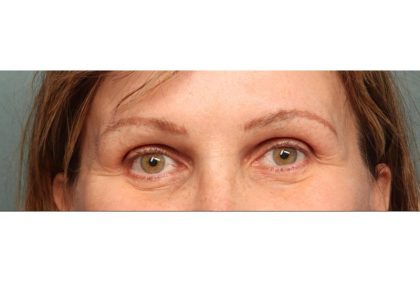 Brow Lift Before & After Patient #8868