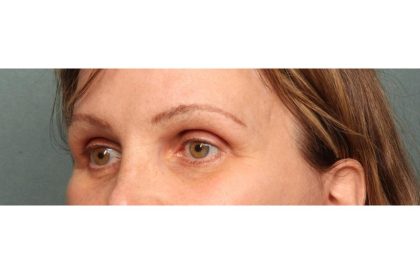 Brow Lift Before & After Patient #8868