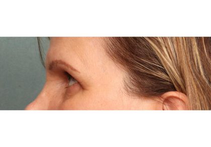 Brow Lift Before & After Patient #8868