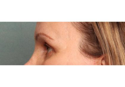Brow Lift Before & After Patient #8868