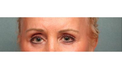Brow Lift Before & After Patient #8869