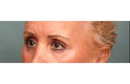 Brow Lift Before & After Patient #8869