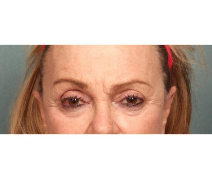 Brow Lift Before & After Patient #8870