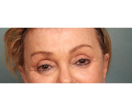Brow Lift Before & After Patient #8870
