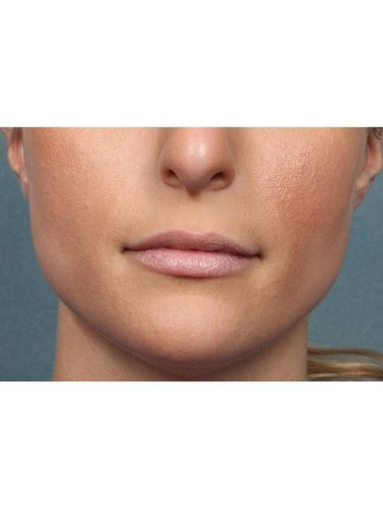 Juvederm Vollure Before & After Patient #9078