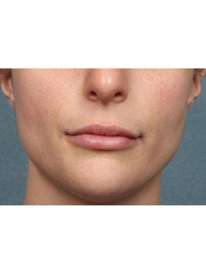 Juvederm Vollure Before & After Patient #9078