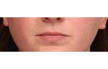 Lip Augmentation Before & After Patient #9026