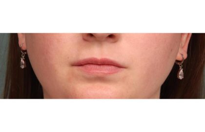 Lip Augmentation Before & After Patient #9026