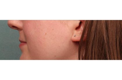 Lip Augmentation Before & After Patient #9026
