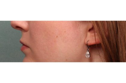 Lip Augmentation Before & After Patient #9026