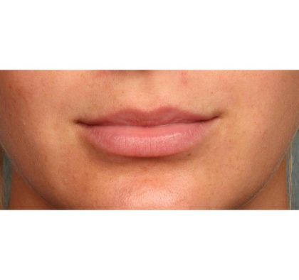 Lip Augmentation Before & After Patient #9027