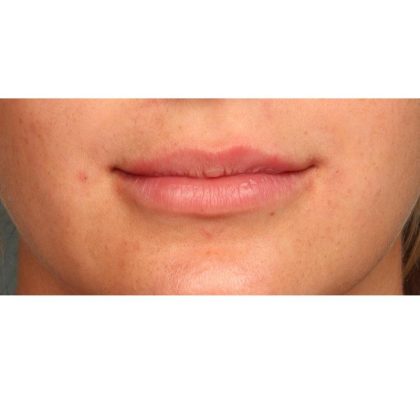 Lip Augmentation Before & After Patient #9027