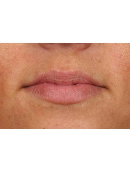 Lip Augmentation Before & After Patient #9028