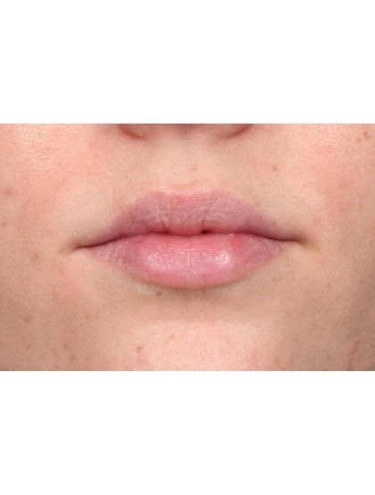 Lip Augmentation Before & After Patient #9028