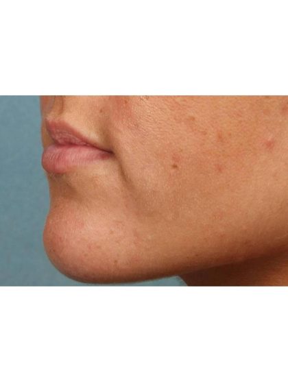 Lip Augmentation Before & After Patient #9028