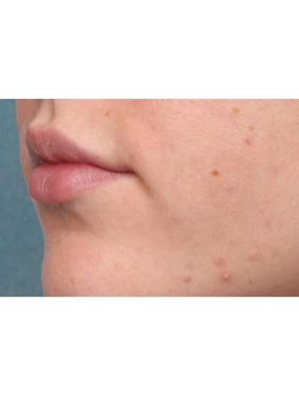 Lip Augmentation Before & After Patient #9028