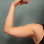 Arm Lift Before & After Patient #9541