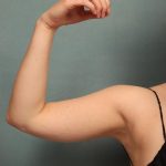 Arm Lift Before & After Patient #9541