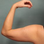 Arm Lift Before & After Patient #9541