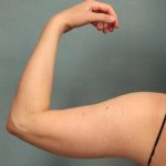 Arm Lift Before & After Patient #9541
