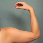 Arm Lift Before & After Patient #9541