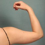 Arm Lift Before & After Patient #9541