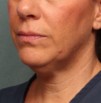 Neck Lift Before & After Patient #9545