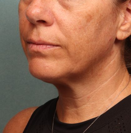 Neck Lift Before & After Patient #9545