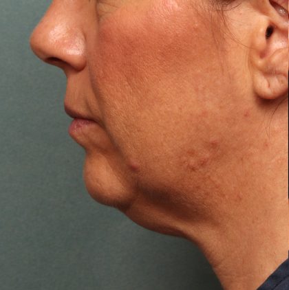Neck Lift Before & After Patient #9545