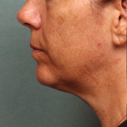 Neck Lift Before & After Patient #9545