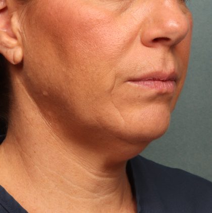 Neck Lift Before & After Patient #9545