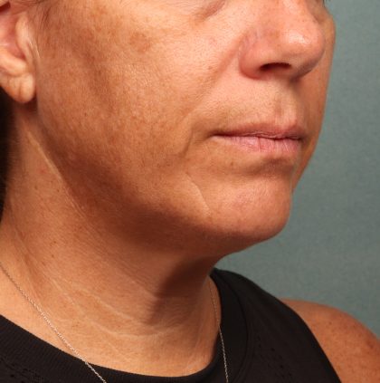 Neck Lift Before & After Patient #9545