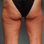 Liposuction Before & After Patient #9546