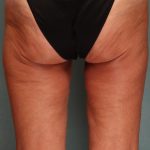 Liposuction Before & After Patient #9546