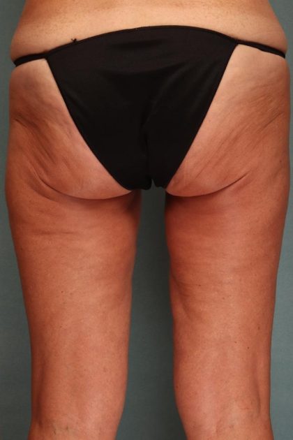 Liposuction Before & After Patient #9546