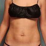 Tummy Tuck Before & After Patient #9547