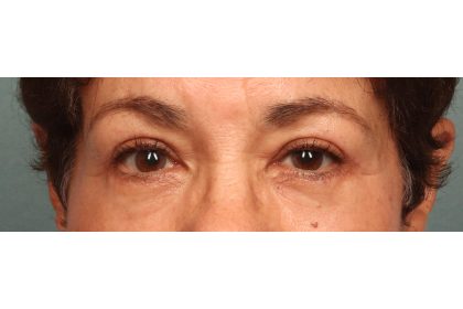 Blepharoplasty Before & After Patient #9548