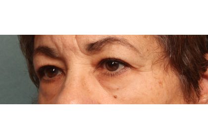 Blepharoplasty Before & After Patient #9548