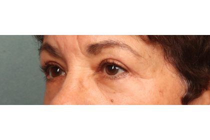 Blepharoplasty Before & After Patient #9548