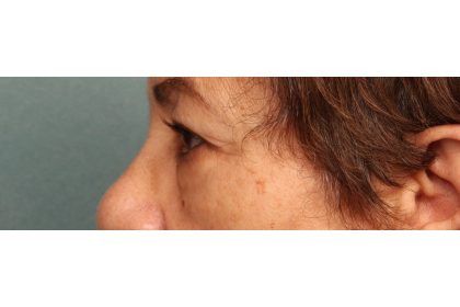 Blepharoplasty Before & After Patient #9548