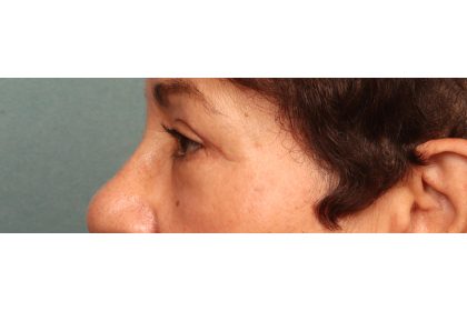 Blepharoplasty Before & After Patient #9548