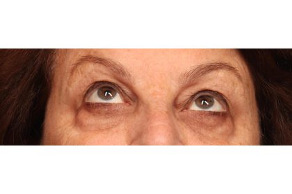 Blepharoplasty Before & After Patient #9669