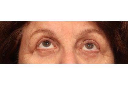 Blepharoplasty Before & After Patient #9669