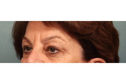 Blepharoplasty Before & After Patient #9669