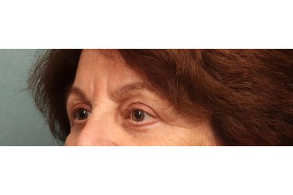 Blepharoplasty Before & After Patient #9669