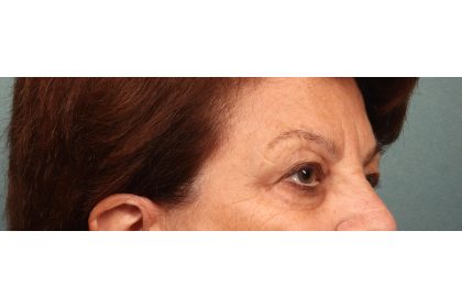 Blepharoplasty Before & After Patient #9669