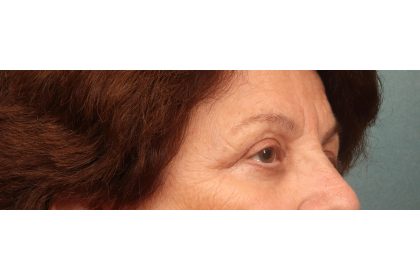 Blepharoplasty Before & After Patient #9669