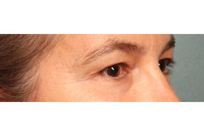 Blepharoplasty Before & After Patient #9671
